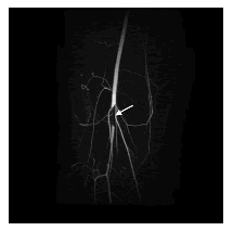 Angio-RM de la región poplítea (imagen coronal): se demuestra la zona de compresión y ausencia de flujo segmentario
de la arteria poplítea en ese lugar (flecha blanca).