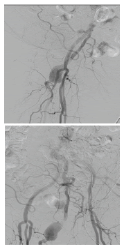 Arteriograf&iacute;a por cat&eacute;ter: con un cat&eacute;ter pigtail en la  bifuraci&oacute;n a&oacute;rtica, se visualiza permeabilidad de las arterias  il&iacute;aca com&uacute;n, il&iacute;aca externa, femoral com&uacute;n y femoral superficial 
  derechas. La arteria ci&aacute;tica persistente derecha es permeable, con  degeneraci&oacute;n aneurism&aacute;tica proximal. Hay ateromatosis de la  arteria femoral superficial derecha en su tercio medio. Las arterias 
  il&iacute;acas y femorales izquierdas son normales.