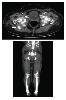 Angiotomograf&iacute;a con contraste en equipo de 64 multidetectores:  se observa una arteria ci&aacute;tica persistente derecha (flecha).,  la cual presenta un aneurisma con trombo mural, que produce disminuci&oacute;n  del 50 % de su luz. Dicha arteria se origina en la arteria  il&iacute;aca interna y finaliza en la segunda porci&oacute;n de la arteria popl&iacute;tea.