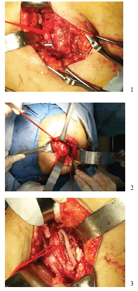 1. Aneurisma de arteria ci&aacute;tica persistente, nervio ci&aacute;tico
  adherido (flecha). 2. Control proximal y distal del Aneurisma de
  arteria ci&aacute;tica persistente 3. Reconstrucci&oacute;n con injerto de vena
  safena invertida.
