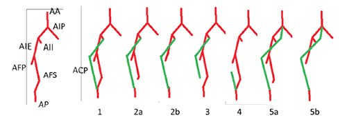 Clasificaci&oacute;n de la arteria ci&aacute;tica persistente, seg&uacute;n Gauffre, et al.: tipo 1, arteria ci&aacute;tica persistente completa 
  y arteria femoral superficial normal; tipo 2a, arteria ci&aacute;tica persistente completa y arteria femoral superficial incompleta, 
  que no comunica con la arteria popl&iacute;tea; tipo 2b, arteria ci&aacute;tica persistente completa y arteria femoral superficial ausente; 
  tipo 3: arteria ci&aacute;tica persistente incompleta (parte superior) y arteria femoral superficial normal; tipo 4, arteria ci&aacute;tica 
  persistente incompleta (parte inferior) y arteria femoral superficial normal; tipo 5a, arteria ci&aacute;tica persistente completa 
  procedente de la sacra media y arteria femoral superficial desarrollada pero incompleta, y tipo 5b, arteria ci&aacute;tica persistente 
  completa procedente de la sacra media y arteria femoral superficial hipopl&aacute;sica.