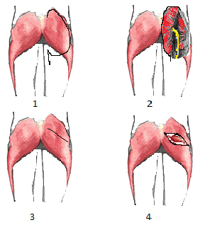 Abordaje quir&uacute;rgico transgl&uacute;teo: 1) incisi&oacute;n con colgajo  del m&uacute;sculo gl&uacute;teo mayor; 2) exposici&oacute;n del nervio ci&aacute;tico y de la  arteria ci&aacute;tica persistente; 3) incisi&oacute;n para abordaje transmuscular 
  de arteria ci&aacute;tica persistente, y 4) exposici&oacute;n de la arteria ci&aacute;tica 
  persistente.
