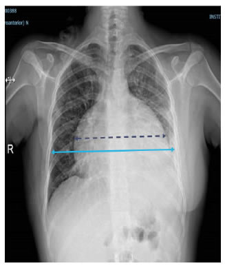 Radiograf&iacute;a de t&oacute;rax: derrame peric&aacute;rdico, ensanchamiento 
  de la silueta 
  cardiomediast&iacute;nica (l&iacute;nea punteada) y derrame
  pleural izquierdo.