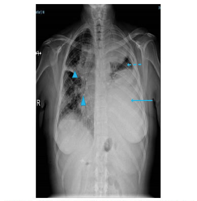 Radiograf&iacute;a de t&oacute;rax: derrame pleural izquierdo. La 
  flecha muestra opacidad de los dos tercios inferiores del hemit&oacute;rax  izquierdo y, la flecha punteada, 'atrapamiento' pulmonar'. En el  hemit&oacute;rax derecho, las opacidades (cabezas de flechas) sugieren 
  linfangitis carcinomatosa, en el contexto de la enfermedad.