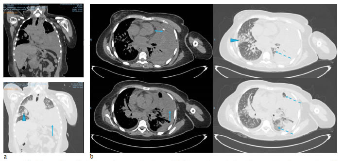 Tomograf&iacute;a axial de t&oacute;rax: derrame pleural y peric&aacute;rdico, y atrapamiento pulmonar; a) cortes coronales y b)  cortes axiales. Las cabezas de flecha muestran imagen de linfangitis carcinomatosa, la flecha, el derrame pleural izquierdo  y, la doble flecha, el derrame peric&aacute;rdico con separaci&oacute;n de 1,2 cm del pericardio. La flecha punteada indica las zonas de  'atrapamiento' pulmonar.