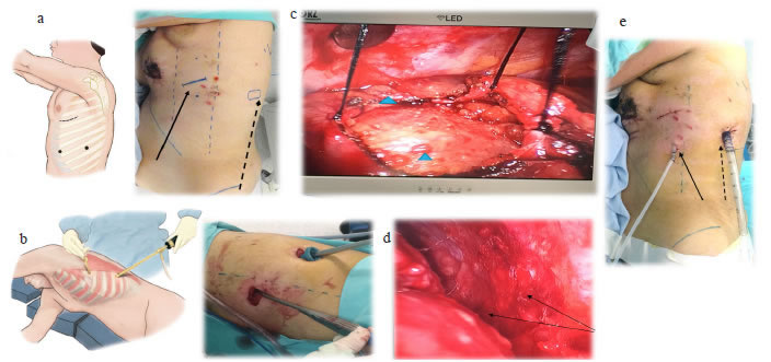 Ventana peric&aacute;rdica por VATS. a y b) El esquema y la fotograf&iacute;a muestran la disposici&oacute;n del paciente en dec&uacute;bito  lateral derecho. La l&iacute;nea punteada se&ntilde;ala la incisi&oacute;n para el puerto de c&aacute;mara en la evaluaci&oacute;n toracosc&oacute;pica. La flecha se&ntilde;ala  la incisi&oacute;n de trabajo de la VATS. c) Imagen del monitor de toracoscopia: las cabezas de flechas muestran los implantes  tumorales en el pericardio parietal y el visceral, durante el procedimiento de la ventana peric&aacute;rdica. d) Las flechas se&ntilde;alan  implantes en la pleura visceral y la pulmonar. e) La flecha punteada muestra la utilizaci&oacute;n del puerto de c&aacute;mara para colocar 
  el tubo de t&oacute;rax. La flecha muestra la salida del cat&eacute;ter subcut&aacute;neo (tunnelized) pleuroperic&aacute;rdico, dos a tres cm por debajo 
  de la incisi&oacute;n, sobre la l&iacute;nea axilar anterior.