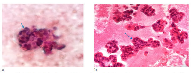 a) Citolog&iacute;a de l&iacute;quido peric&aacute;rdico: se observa fondo hemorr&aacute;gico con escasos grupos de c&eacute;lulas  de aspecto epitelial (flecha) con ligera atipia. Tinci&oacute;n de Papanicolaou, 40X. b) Bloque celular de l&iacute;quido  peric&aacute;rdico: se observan grupos de c&eacute;lulas epiteliales formando estructuras glandulares (flecha punteada)  con n&uacute;cleos ovales con ligera at&iacute;pica, cromatina grumosa y escaso citoplasma; tambi&eacute;n, se observan escasas c&eacute;lulas mesoteliales. Hematoxilina y eosina, 100X.