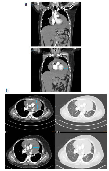 TC de t&oacute;rax. a. Cortes coronales: derrame peric&aacute;rdico
    homog&eacute;neo y sin tabiques. b. Cortes axiales: separaci&oacute;n de 3,5 cm
    entre las hojas del pericardio (doble flecha). No se observa engrosamiento
    del pericardio y hay un escaso derrame pleural izquierdo.