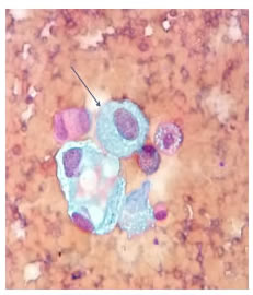 Citolog&iacute;a de l&iacute;quido peric&aacute;rdico. Se observa un fondo
  hemorr&aacute;gico, c&eacute;lulas mesoteliales con cambios reactivos y discreto
  aumento del n&uacute;cleo y el citoplasma (flecha). Diagn&oacute;stico: mesotelio
  reactivo. Tinci&oacute;n de Papanicolaou, 40X.