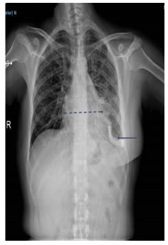 Radiograf&iacute;a de t&oacute;rax despu&eacute;s de tres semanas de la
  ventana peric&aacute;rdica: cat&eacute;ter pleuroperic&aacute;rdico izquierdo (flecha),
  adecuada expansi&oacute;n pulmonar izquierda y disminuci&oacute;n del tama&ntilde;o
de la silueta cardiomediast&iacute;nica.
