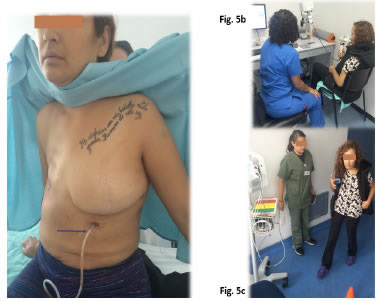 a. Cat&eacute;ter pleuroperic&aacute;rdico (flecha) permeable y sin
  signos de infecci&oacute;n despu&eacute;s de tres semanas de instalado. b y c.
  Rehabilitaci&oacute;n cardiopulmonar posoperatoria.