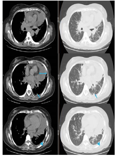 PEC-CT, ventanas mediastinal y pulmonar: derrame
  peric&aacute;rdico. La doble flecha muestra una separaci&oacute;n de 2 cm del
  pericardio, la flecha se&ntilde;ala los implantes pleurales y, la cabeza de
  flecha, el engrosamiento pleural.