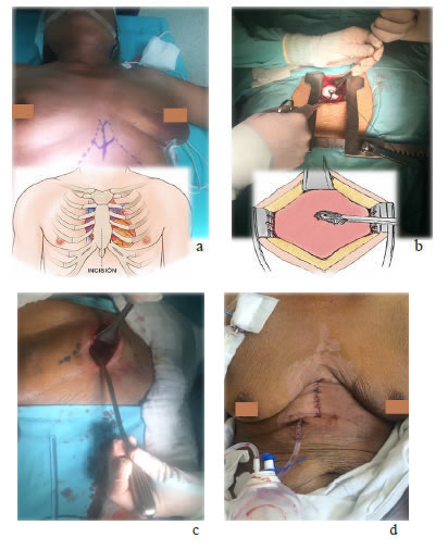 Ventana peric&aacute;rdica subxifoidea e instalaci&oacute;n del cat&eacute;ter peric&aacute;rdico subcut&aacute;neo (tunnelized): 
  a) Marcaci&oacute;n del ap&eacute;ndice xifoides
  y l&iacute;mites de la incisi&oacute;n; b) Exposici&oacute;n del saco peric&aacute;rdico con separador de Finochietto, 
  disecci&oacute;n roma y separaci&oacute;n del diafragma y la 
  grasa mediastinal; c) Evacuaci&oacute;n del derrame peric&aacute;rdico;
  d) Instalaci&oacute;n del cat&eacute;ter subcut&aacute;neo (tunnelized) peric&aacute;rdico.