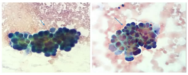 Estudio citol&oacute;gico del derrame peric&aacute;rdico maligno: se observa un fondo hemorr&aacute;gico (flecha
  corta) con abundantes c&eacute;lulas neopl&aacute;sicas que forman m&oacute;rulas y rosetas (flecha larga). Tienen citoplasma
  amplio y n&uacute;cleos grandes y pleomorfos. Diagn&oacute;stico citol&oacute;gico de l&iacute;quido peric&aacute;rdico: carcinoma. Tinci&oacute;n
  de Papanicolaou, 40X.