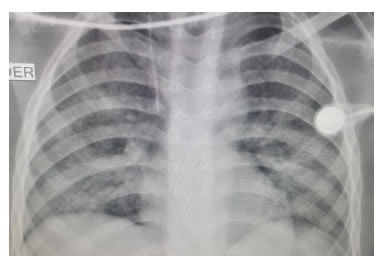 Tuberculosis pulmonar: radiograf&iacute;a de t&oacute;rax con opacidades
  en vidrio esmerilado en ambos capos pulmonares.