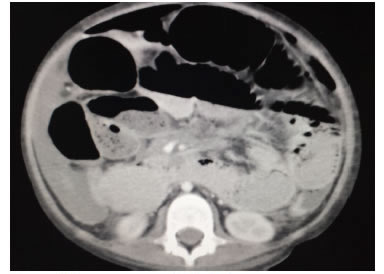Neumoperitoneo: TC de abdomen con aire interasas y
  signos de obstrucci&oacute;n intestinal dados por niveles hidroa&eacute;reos y
  distensi&oacute;n de asas delgadas.