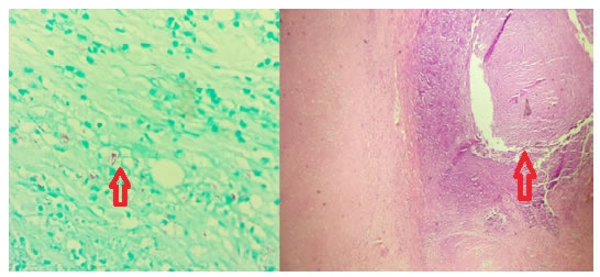 A. Bacilos &aacute;cido-alcohol resistentes. Coloraci&oacute;n Ziehl-Neelsen a 100X B. Granulomas
  con necrosis de caseificaci&oacute;n. Hematoxilina-eosina 100X.