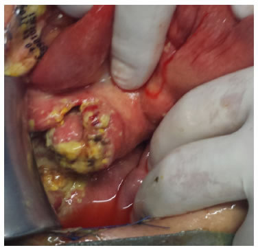 Ganglios con necrosis de caseificaci&oacute;n en el mesenterio.