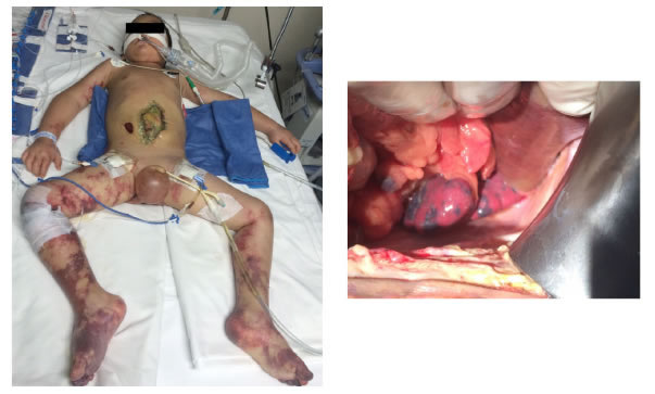 P&uacute;rpura fulminante en extremidades y bazo.