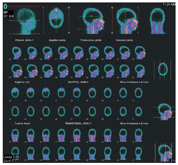 Gammagraf&iacute;a cerebral con leucocitos marcados con 99mTc-HMPAO. No se observa concentraci&oacute;n
  del trazador en el par&eacute;nquima cerebral (signo de la calota vac&iacute;a).