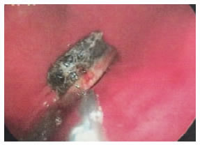 Bezoar gástrico de plástico, un cepillo dental.