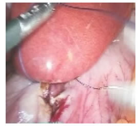 Cierre de gastrotomía anterior por sutura
  laparoscópica y nudos intracorpóreos.