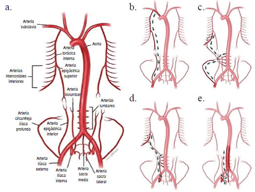 a. Vias colaterales sistémicas, en oclusión aortoilíaca. b. Arteria subclavia; arteria torácica 
  interna; arteria epigástrica superior; arteria epigástrica inferior; arteria ilíaca externa. c. arterias intercostales 
  inferiores; arterias lumbares; ramo ascendente de la arteria circunfleja iliaca externa; arteria iliaca 
  externa. d. Arterias intercostales inferiores, arterias lumbares; arteria iliolumbar; arteria iliaca interna. 
  e. Aorta abdominal; arteria sacra media; arteria iliolumbar; arteria sacra lateral; arteria iliaca interna. 
  Reproducido y traducido con autorización de: Anatomical significance in aortoiliac occlusive disease. Clin 
  Anat. 2014;27:1264-74