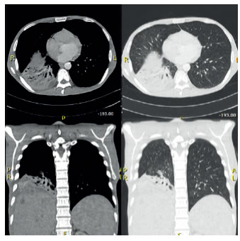Tomograf&iacute;a computarizada de t&oacute;rax: cortes axiales  mediante t&eacute;cnica helicoidal y reconstrucciones de 3 mm, despu&eacute;s
  de la administraci&oacute;n del medio de contraste intravenoso (75 ml  de iohexol) extenso compromiso parenquimatoso pulmonar en el 
  l&oacute;bulo inferior derecho, tabiques en la pleura parietal hacia el  aspecto medial del l&oacute;bulo inferior derecho y una zona que podr&iacute;a  corresponder a una neumon&iacute;a necrosante