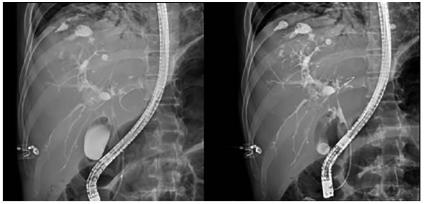 CPRE: m&uacute;ltiples irregularidades y dilataciones saculares por colangitis, con formaci&oacute;n de una colecci&oacute;n en los
  segmentos superiores, y disminuci&oacute;n importante del calibre del conducto hep&aacute;tico com&uacute;n