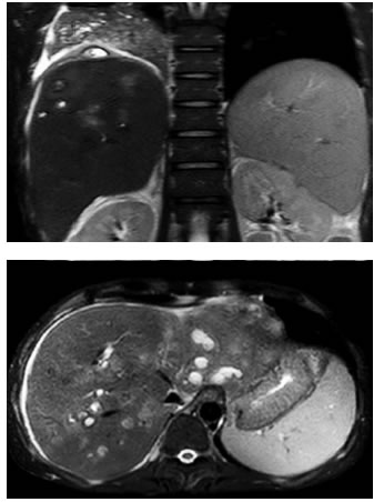 Resonancia magn&eacute;tica de abdomen con Primovist&reg; donde  se evidencian m&uacute;ltiples abscesos, uno de ellos con compromiso
  extrahep&aacute;tico subdiafragm&aacute;tico y en &iacute;ntima relaci&oacute;n con el l&oacute;bulo  pulmonar inferior derecho