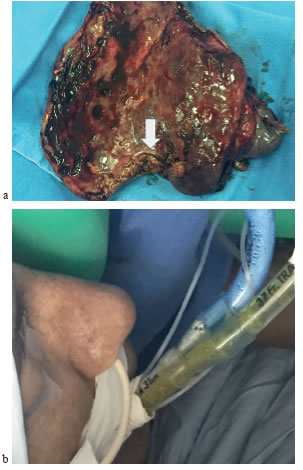 a. Pieza quir&uacute;rgica de la lobectom&iacute;a inferior derecha:  f&iacute;stula en su borde inferior (flecha).
  b. Presencia de bilis en el tubo  de doble luz