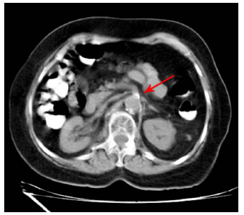 Aortograma. La flecha roja muestra una estenosis del 70
  % de la arteria mesent&eacute;rica superior