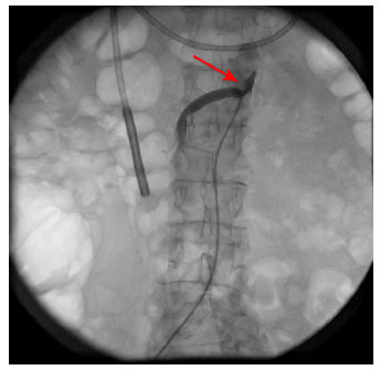 Corte axial de TC de abdomen. La flecha roja muestra
  seria enfermedad arterioescler&oacute;tica de la aorta