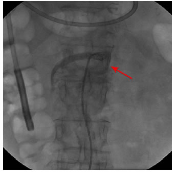 Aortograma. La flecha roja muestra la endopr&oacute;tesis (stent)
  en la arteria mesent&eacute;rica superior