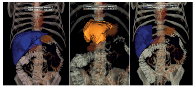 Volumetr&iacute;a hep&aacute;tica para el c&aacute;lculo del volumen funcional residual.