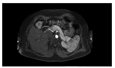 Resonancia magn&eacute;tica con contraste de abdomen, de 1,5 
teslas (T).
Se identifican cambios anat&oacute;micos g&aacute;stricos posquir&uacute;rgicos. No se
encontraron lesiones en el par&eacute;nquima pancre&aacute;tico ni dilataci&oacute;n del
conducto principal, tampoco se observan &aacute;reas de realce temprano
que sugieran tumor intrapancre&aacute;tico.