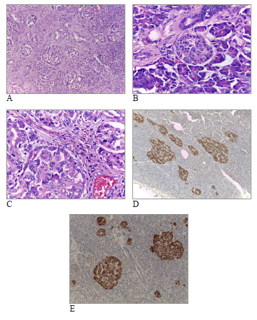 Nesidioblastosis del adulto. A: M&aacute;s de 10 islotes de Langerhans
con diferentes tama&ntilde;os, en la vecindad de los conductos
pancre&aacute;ticos. Hematoxilina y eosina, 200X. B: Agrandamiento
nuclear en c&eacute;lulas de los islotes de Langerhans. Hematoxilina y
eosina, 400X. C: C&eacute;lulas de los islotes con hipercromasia nuclear.
Variabilidad en el tama&ntilde;o de los islotes. Hematoxilina y eosina,
400X. D: Inmunohistoquimica: CD56 positivo en islotes de Langerhans.
Variabilidad en el tama&ntilde;o y aumento del n&uacute;mero de islotes
por &aacute;rea. 200X. E: Inmunohistoquimica: Cromogranina. M&uacute;ltiples
islotes de variable forma y tama&ntilde;o, algunos alrededor del conducto
pancre&aacute;tico. 200X.