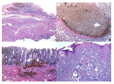 Estudio anatomopatol&oacute;gico. A. Agregado nodular de
c&eacute;lulas pigmentadas at&iacute;picas con crecimiento intramucoso. Hematoxilina
y eosina, lupa. B. La misma imagen con mayor aumento.
Hematoxilina y eosina, 10X. C. Melanoma que infiltra m&aacute;s all&aacute;
de la muscularis mucosa, con patr&oacute;n de peque&ntilde;os nidos y c&eacute;lulas
sueltas hiperpigmentadas, a distancia de la lesi&oacute;n nodular descrita,
en otra zona de la mucosa del colon. Hematoxilina y eosina, 10 X.
D. Crecimiento pagetoide de las c&eacute;lulas mel&aacute;nicas malignas en el
epitelio escamoso anorrectal. Hematoxilina y eosina, 10X.