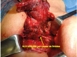 C&aacute;ncer de tiroides con infiltraci&oacute;n del nervio lar&iacute;ngeo recurrente.