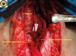 Se visualiza la reconstrucci&oacute;n del nervio lar&iacute;ngeo recurrente izquierdo con la t&eacute;cnica de Horsley (c&iacute;rculo azul).