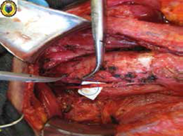 Tiroidectom&iacute;a total con vaciamiento ganglionar central; se visualiza la reconstrucci&oacute;n del nervio lar&iacute;ngeo recurrente izquierdo con la t&eacute;cnica de Horsley (c&iacute;rculo azul).