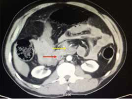 Neumoretroperitoneo por lesión duodenal (flecha roja) y lesión de la arteria mesentérica superior (flecha amarilla).