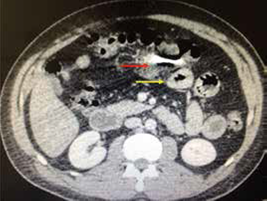 Proyectil en el mesenterio con hematoma (flecha roja) y asas engrosadas de intestino (flecha amarilla).