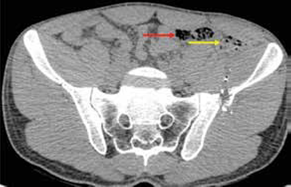 Burbujas de aire extraluminales (flecha amarilla) adyacentes al colon (flecha roja).
