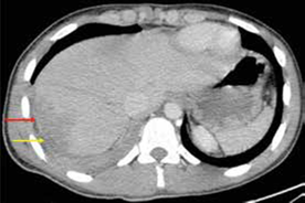 Trauma hepático de grado II (flecha roja) y herida del hemidiafragma derecho (flecha amarilla).