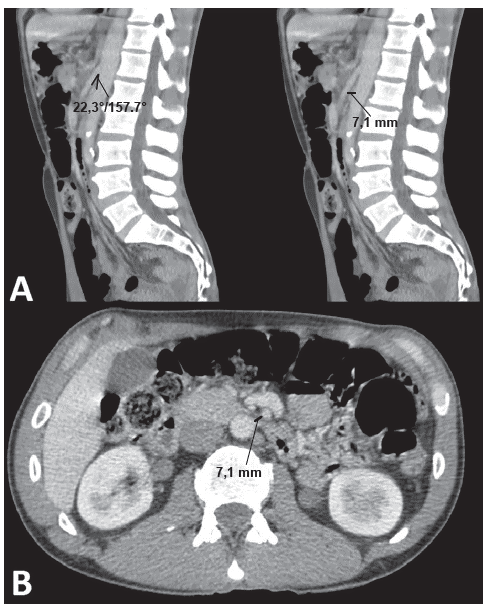A. Cortes sagitales de tomografía en los que se observa un ángulo aortomesentérico menor a 25° y una distancia aortomesentérica menor de 10 mm. B. Distancia aortomesentérica menor de 10 mm en un corte axial.