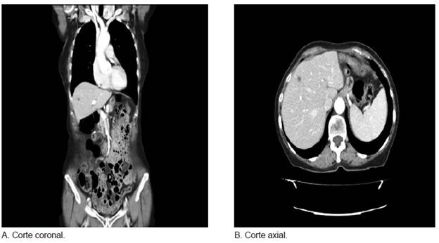 Tomografia computarizada abdomino-p&eacute;lvica en la que se observa una lesi&oacute;n de ocupaci&oacute;n hep&aacute;tica en segmento IVb hipervascularizada.