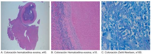 Granuloma necrosante con abundantes bacilos &aacute;cido-alcohol resistentes compatibles con micobacterias.