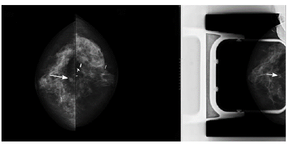 Mamograf&iacute;a. Proyecciones craneocaudales y compresi&oacute;n focal de mama derecha. N&oacute;dulo isodenso en el tercio posterior del cuadrante superior externo de la mama, se&ntilde;alado con flecha. Mama izquierda con fibrosis secundaria a procedimiento quir&uacute;rgico previo, asociado adicionalmente a clip met&aacute;lico.