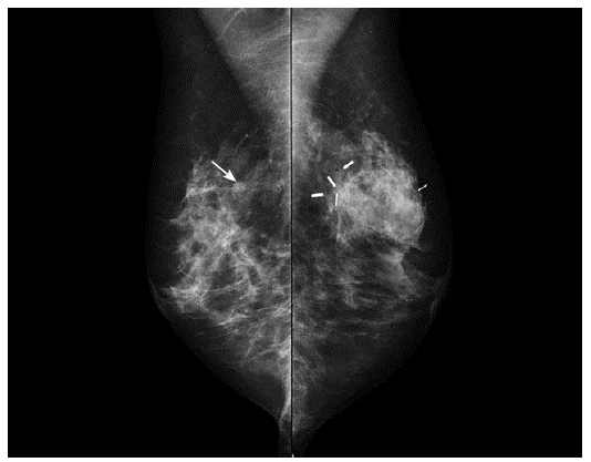Mamograf&iacute;a. Proyecciones oblicuas. N&oacute;dulo isodenso en el tercio posterior del cuadrante superior externo de la mama derecha se&ntilde;alado con flecha. Cambios cicatriciales en la mama izquierda.